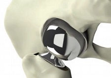 The Furlong Hemiarthroplasty System fro JRI Orthopaedics